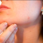 ADHD and Skin Picking