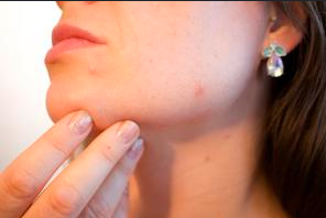 ADHD and Skin Picking